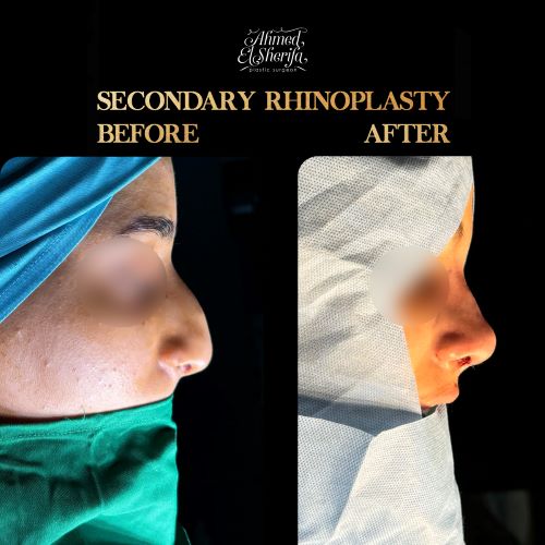 كلفة عملية تجميل الأنف في الرياض